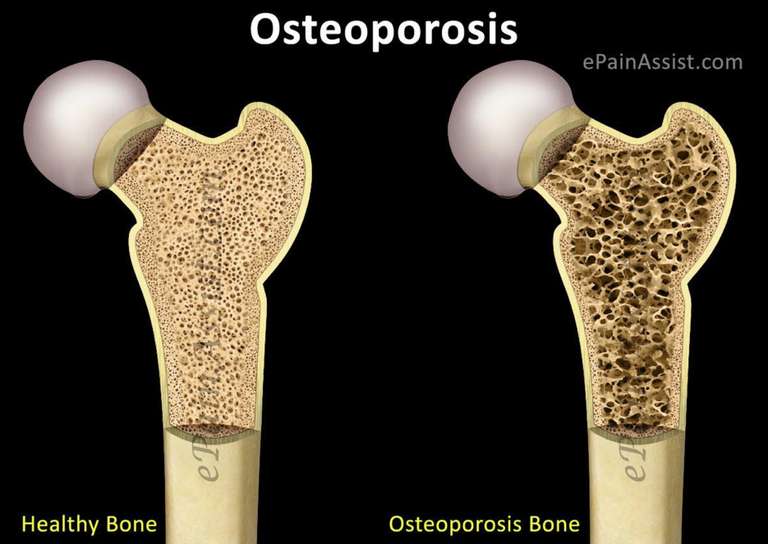Bezpłatne badania w kierunku osteoporozy/kobiety powyżej 60/Swarzędz
